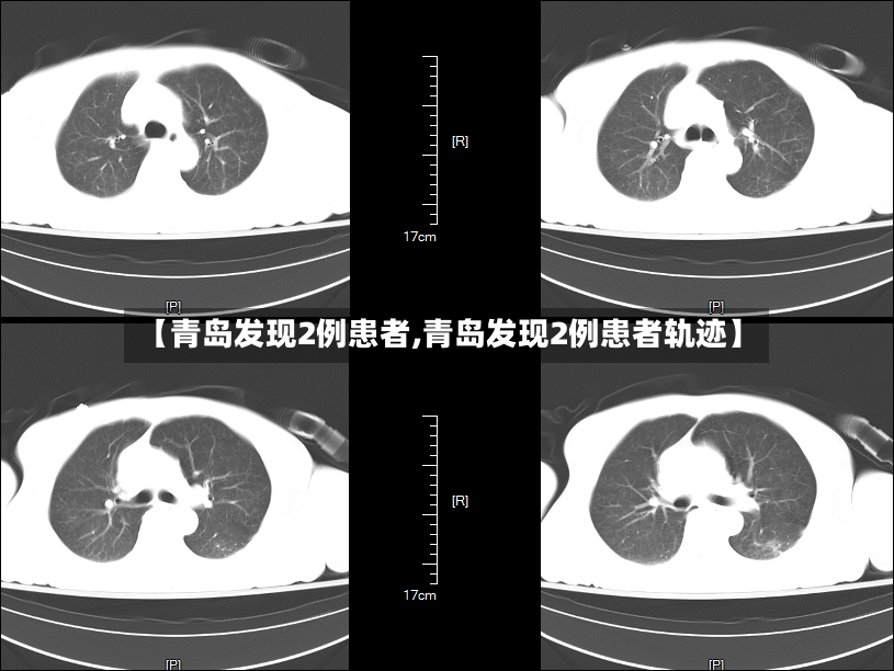 【青岛发现2例患者,青岛发现2例患者轨迹】-第2张图片