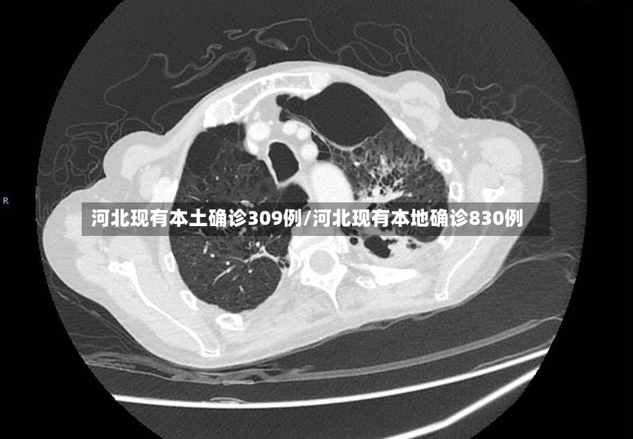 河北现有本土确诊309例/河北现有本地确诊830例