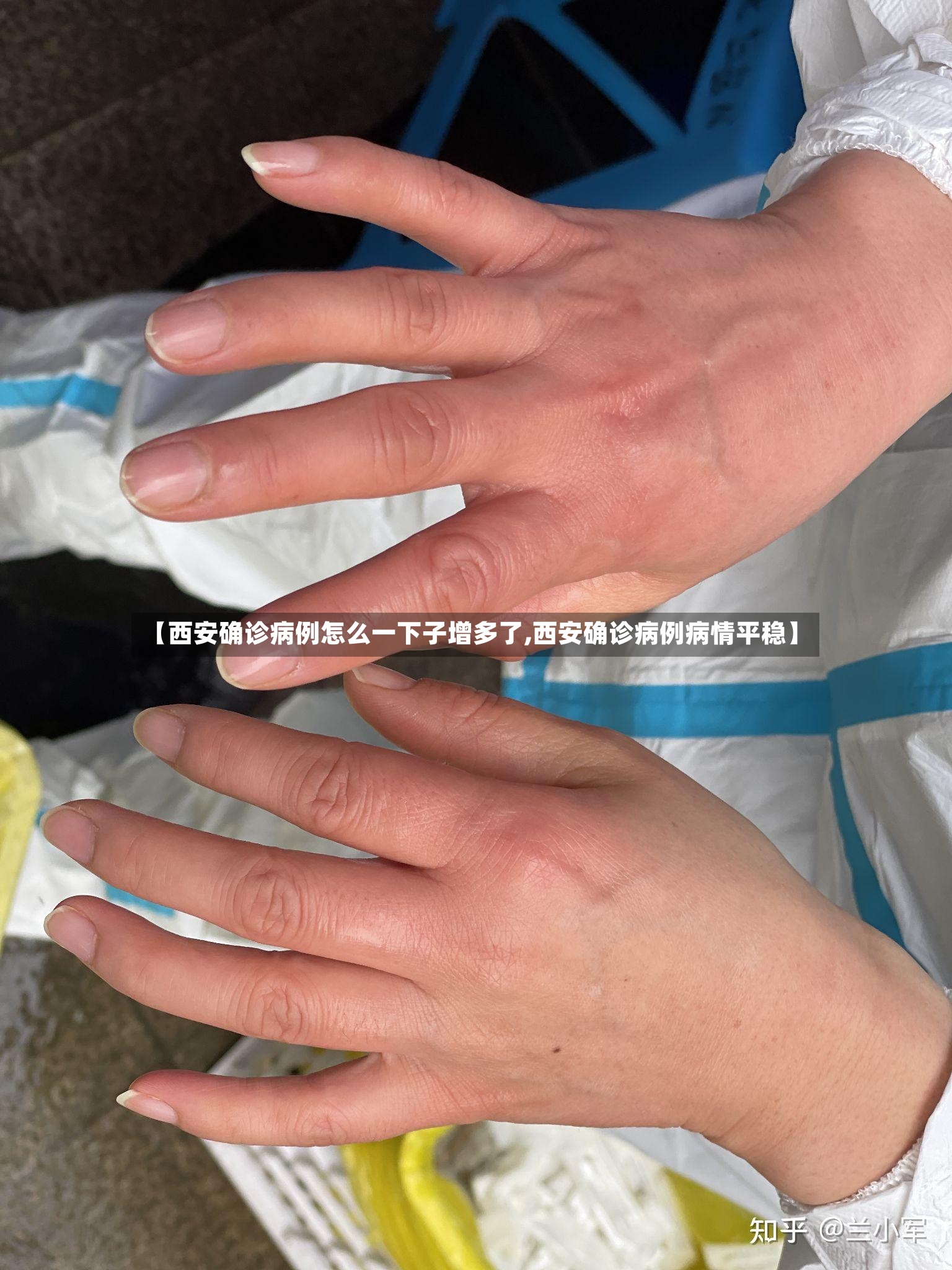【西安确诊病例怎么一下子增多了,西安确诊病例病情平稳】