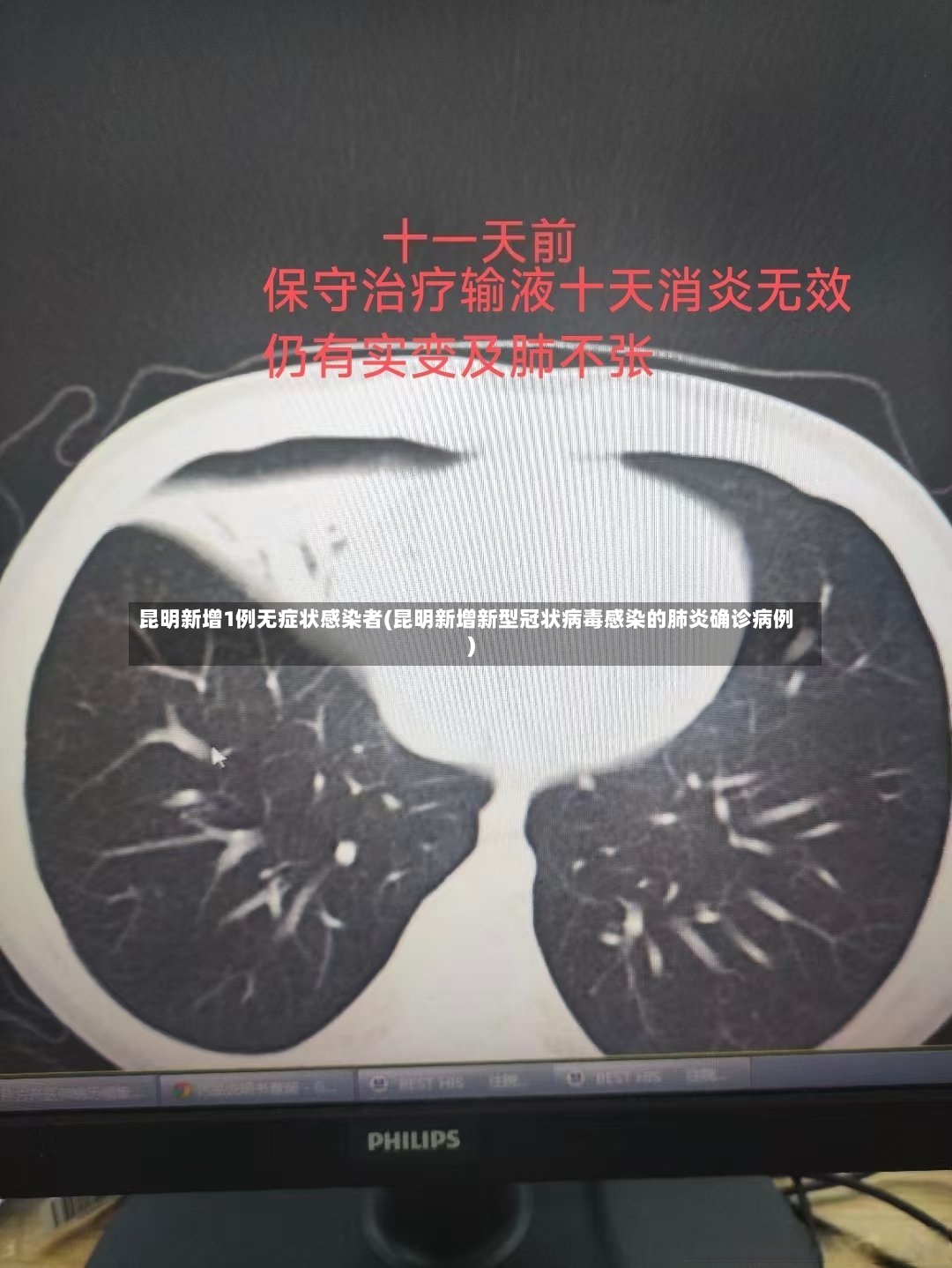 昆明新增1例无症状感染者(昆明新增新型冠状病毒感染的肺炎确诊病例)