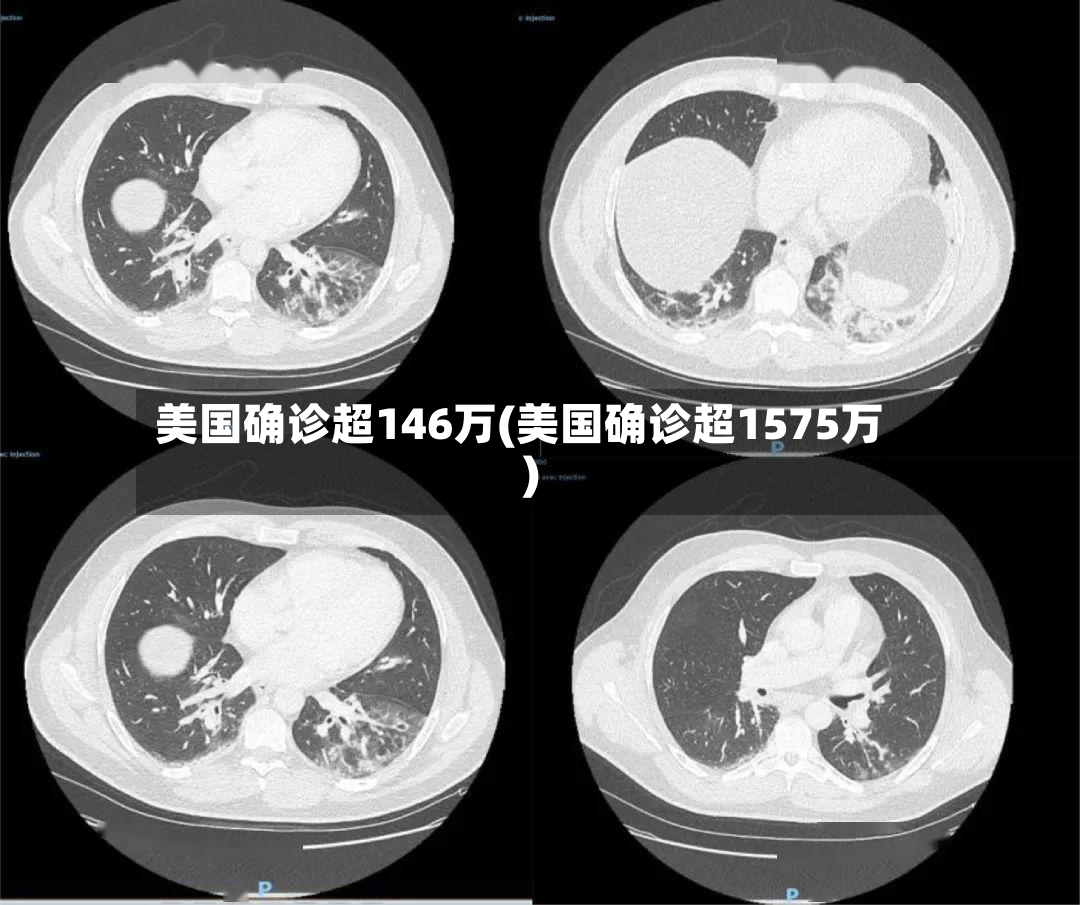 美国确诊超146万(美国确诊超1575万)